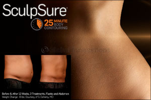 Incorporate SculpSure, the Non-Surgical Fat Treatment, Into Your Busy Schedule