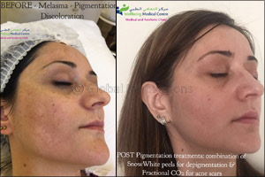 Fractional CO2  - Q&A