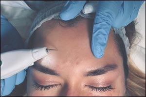 What Procedure I Got Done to My Skin